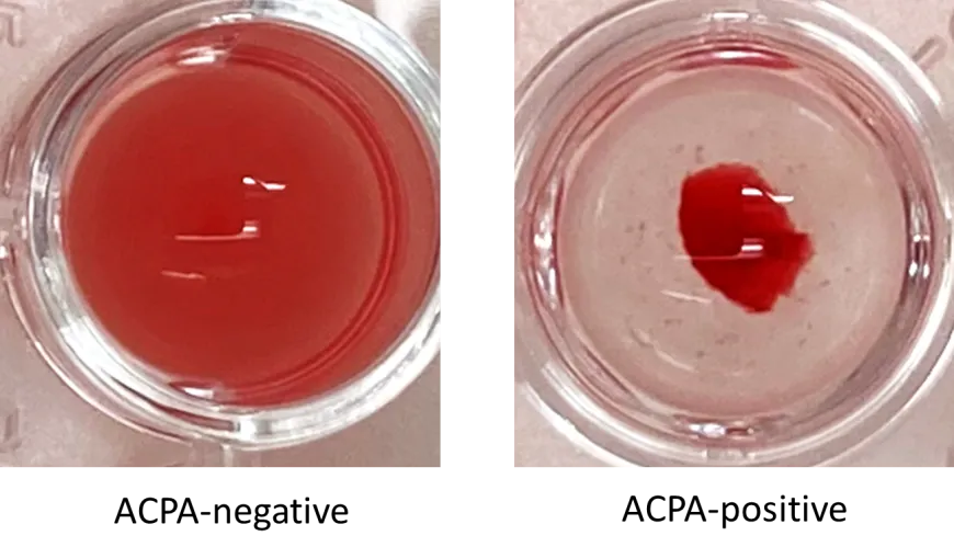 Red blood cell agglutination in an anti-citrullinated protein autoantibody-dependent manner