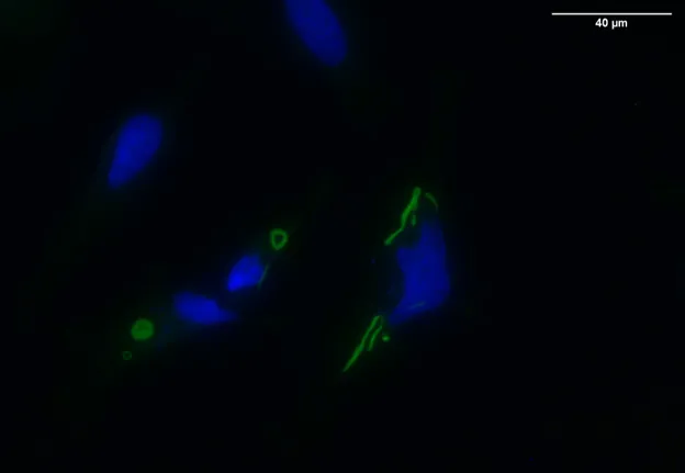 The molecular basis of the accumulation of cytosolic 5’-nucleotidase 1A in inclusion body myositis