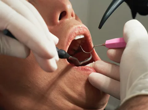 Filling cavities with hand instruments no worse than by drill