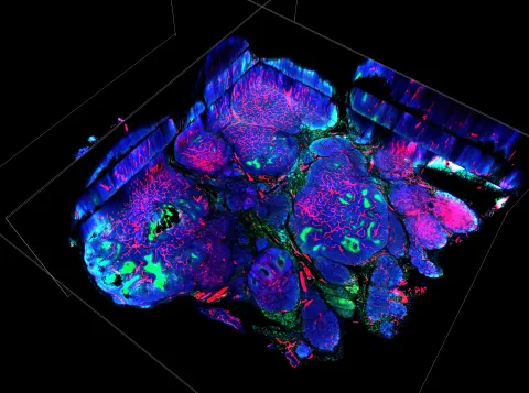Tackling cancer with radioactive particles