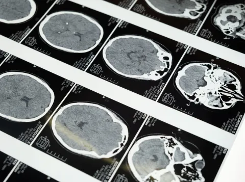 Anxious people use less suitable section of brain to control emotions