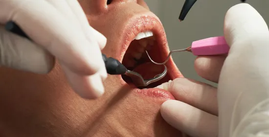 Filling cavities with hand instruments no worse than by drill